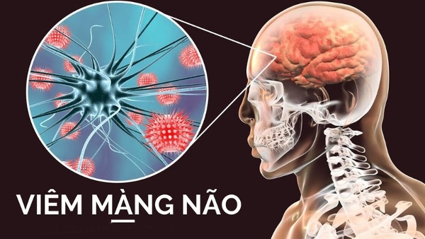 Viêm màng não do vi rút