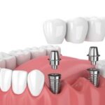 Quy trình trồng răng implant mất bao lâu?