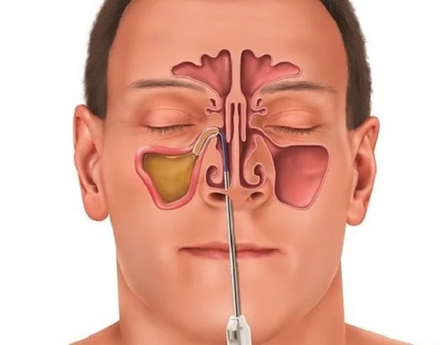 Yếu tố nguy cơ của các bệnh đường hô hấp