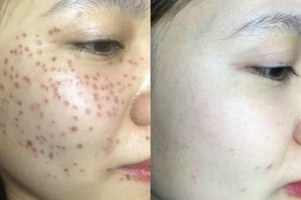 Hướng dẫn xử lý vùng da phồng rộp sau laser