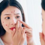 Nặn mụn có làm hết mụn không theo giải thích của chuyên gia