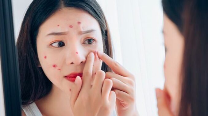 Nặn mụn có làm hết mụn không theo giải thích của chuyên gia Nặn mụn có làm hết mụn không theo giải thích của chuyên gia
