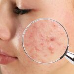 Nguyên nhân gây mụn nội tiết và dấu hiệu nhận biết thường gặp