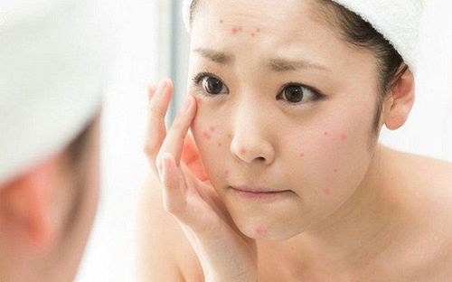 Tìm hiểu nguyên nhân hình thành mụn nội tiết