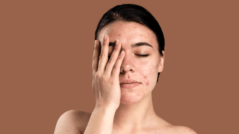 Những thay đổi hormone có thể gây mụn