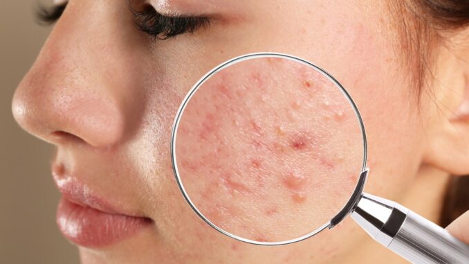 Nguyên nhân gây mụn nội tiết và dấu hiệu nhận biết thường gặp Nguyên nhân gây mụn nội tiết và dấu hiệu nhận biết thường gặp