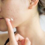 Trị mụn không tái phát có khả thi theo góc nhìn da liễu