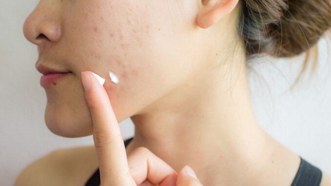 Trị mụn không tái phát có khả thi theo góc nhìn da liễu Trị mụn không tái phát có khả thi theo góc nhìn da liễu